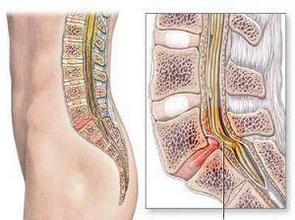 西宁腰椎间盘增生的原因