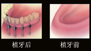 廊坊牙齿美白价格——哪里有提供xx的廊坊牙齿种植