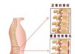 强直性脊柱炎检查