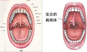 扁桃体切除成人有什么影响