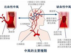 腦中風zl費用怎么樣_中風后遺癥zl醫院