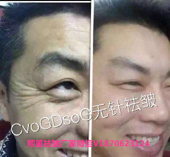 凱進無針去皺加盟