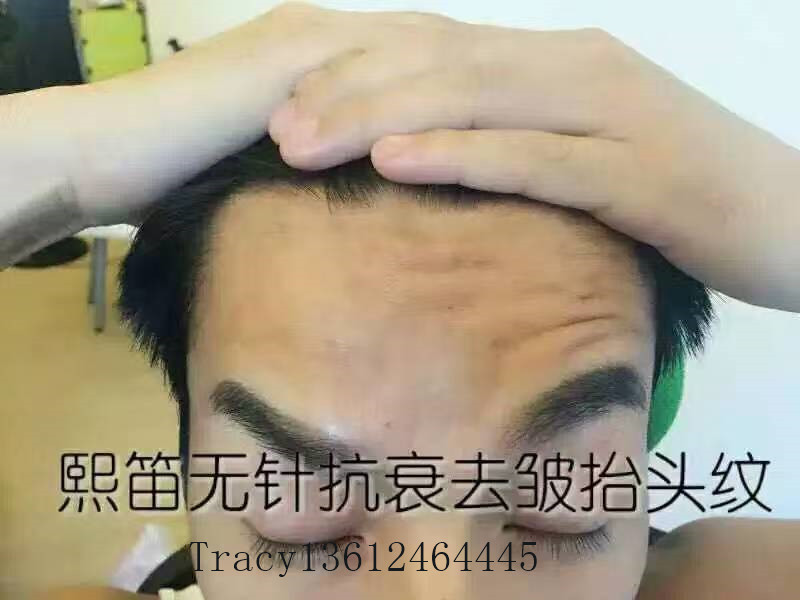 凱進無針去皺加盟
