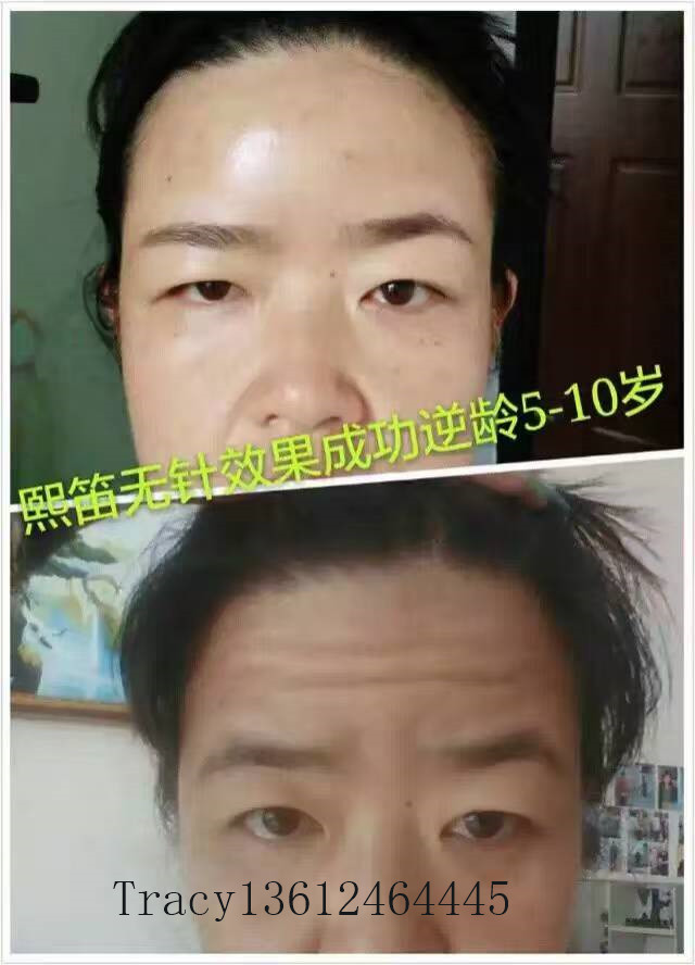 凱進無針去眼袋廠家