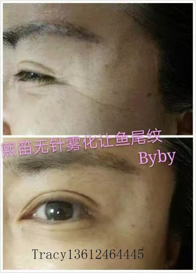 凱進(jìn)無(wú)針去眼袋廠家