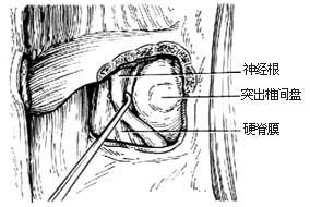 西宁腰椎间盘增生的原因及注意要点