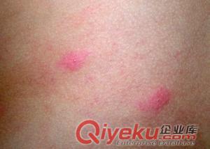 上海華山醫(yī)院皮膚科專(zhuān)家門(mén)診的專(zhuān)家當(dāng)天能排上號(hào)嗎