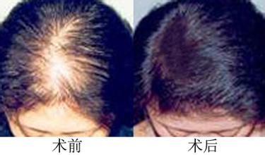 納米無痕毛發移植培訓招生