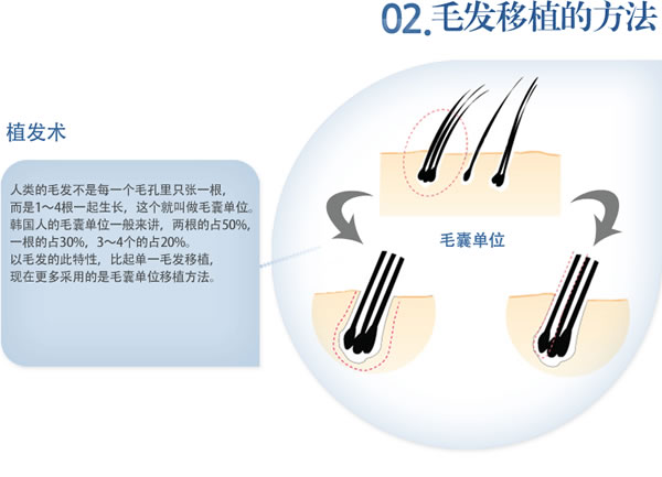 廣州肇慶毛發移植培訓開始招生。