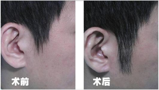 北京FUE植發培訓，北京zzy的的毛發移植培訓