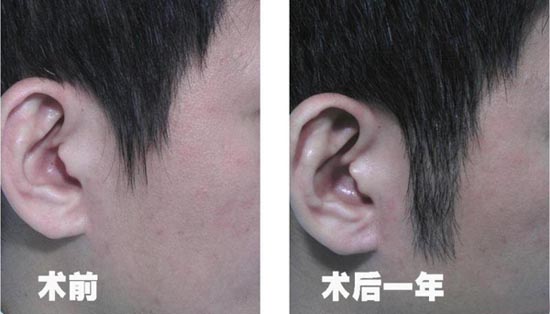 FUE毛發(fā)移植招生培訓(xùn),毛發(fā)種植招生