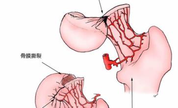 股骨头坏死吃什么好