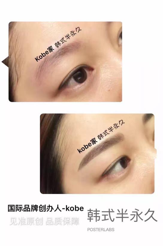 微創雙眼皮價格_微創雙眼皮