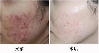 河北效果好的OPT快速脫毛推薦 脫毛廊坊脫毛